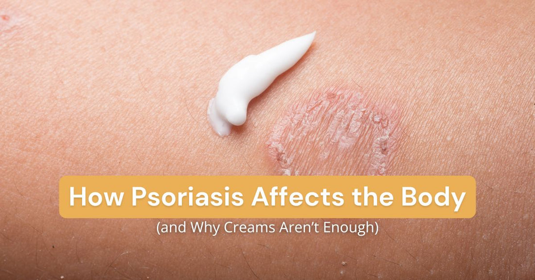 How Psoriasis Affects the Body (and Why Creams Aren’t Enough)